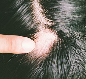Existe prevenção para Alopecia Areata?